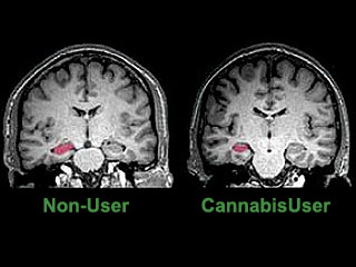 Cannabis & Brain